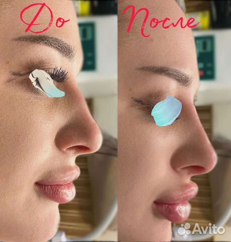 Коррекция формы носа