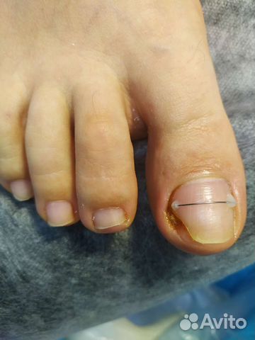 Педикюр, подолог, выезд на дом